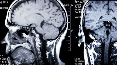 magnetic resonance imaging (MRI). brain. brain scanning. A MRI of a human head back and side view. The MRI is a three-dimensional diagnostic imaging technique used to visualize inside the body without the need for X-rays or other radiation. Health care