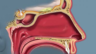 Learn how the olfactory bulb in the brain processes the information from the olfactory receptors lining the nose