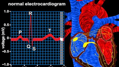 Track ventricle depolarization via the QRS complex in an electrocardiogram to observe electrical conduction