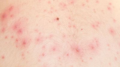 Detail of skin with chicken pox, chickenpox, rash.